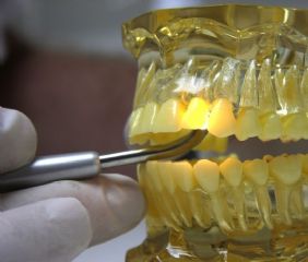 Zahnschmelz Reparieren Zahn Abgebrochen Behandlungsmethode